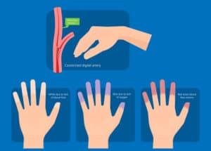 Raynaud'n taudin oire